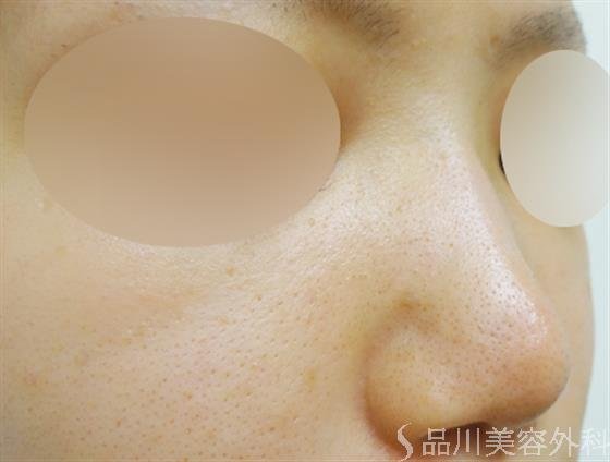 症例NO.23427のAFTER写真
