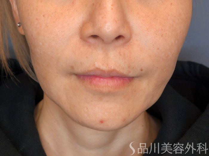 症例NO.67767のBEFORE写真