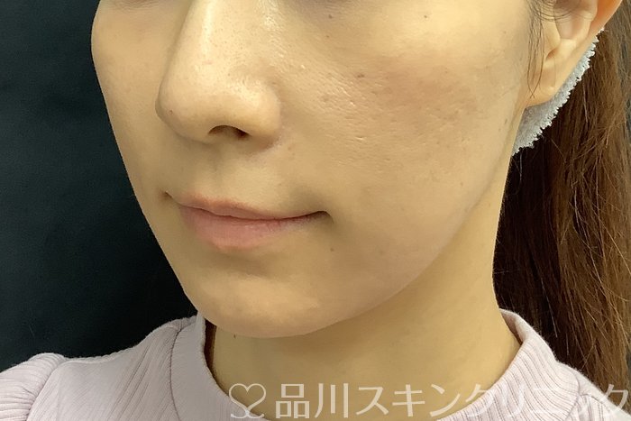 症例NO.69842のBEFORE写真
