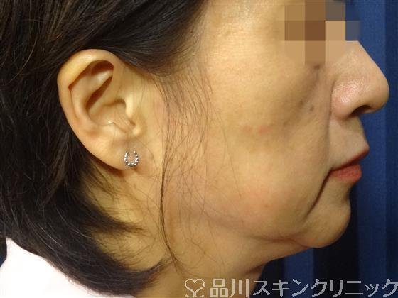 症例NO.32761のBEFORE写真