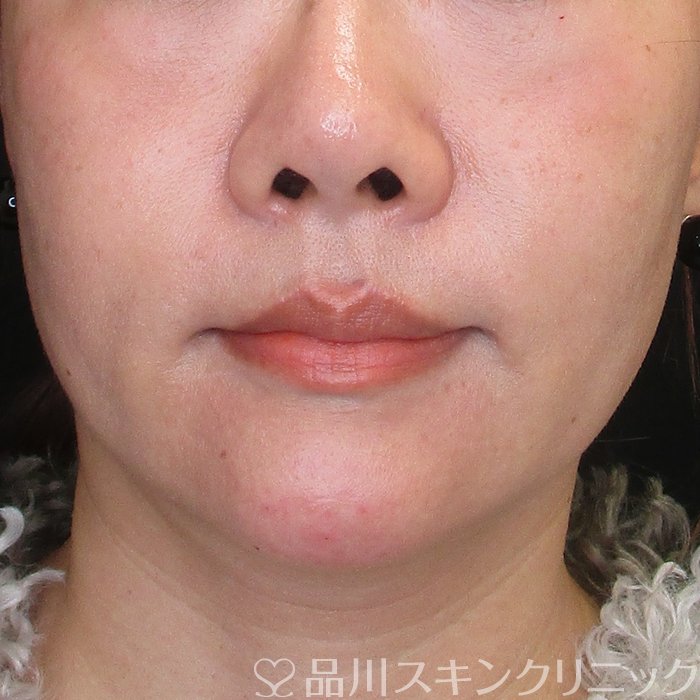 症例NO.73941のAFTER写真