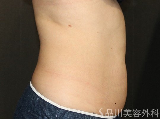 症例NO.74069のAFTER写真