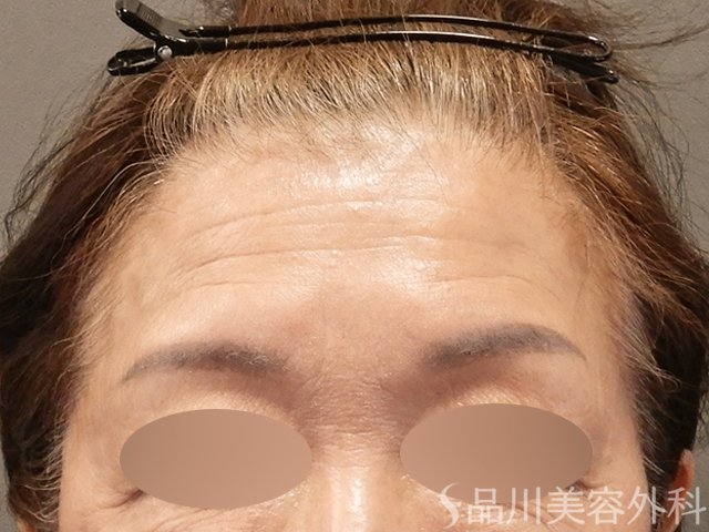 症例NO.72717のBEFORE写真