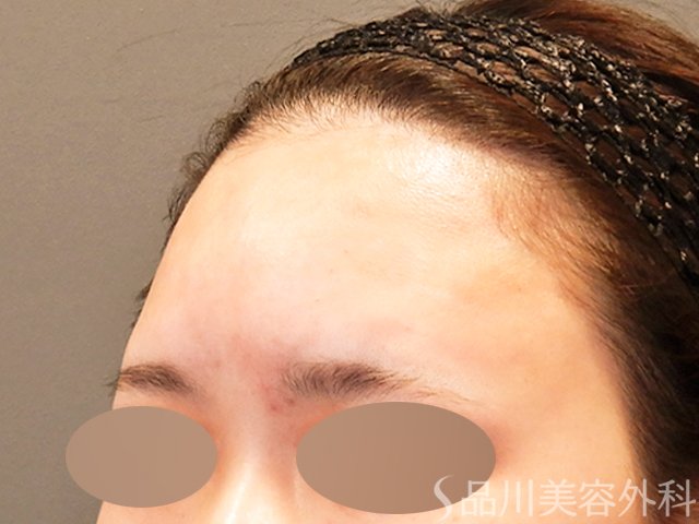 症例NO.69953のAFTER写真