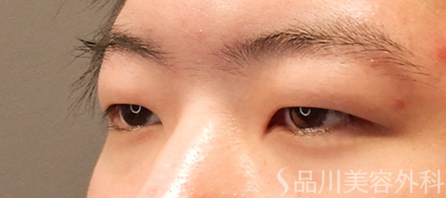 症例NO.72319のBEFORE写真