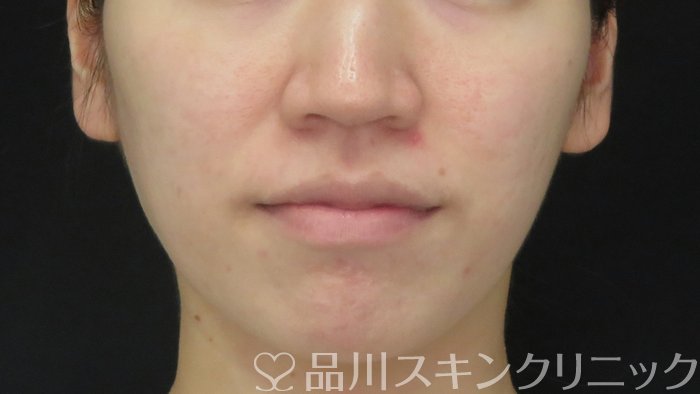 症例NO.71780のAFTER写真