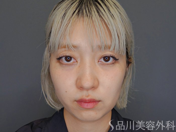 症例NO.65351のAFTER写真