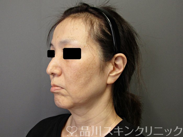 症例NO.74934のBEFORE写真