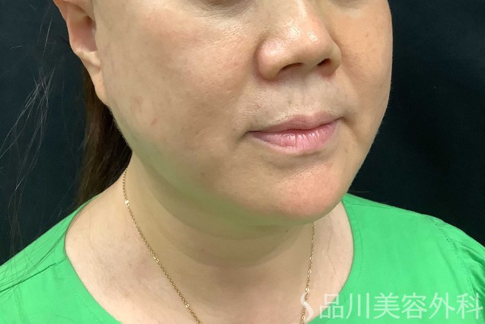 症例NO.71283のBEFORE写真