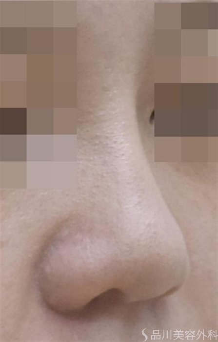 症例NO.48943のAFTER写真