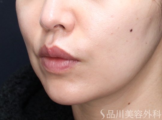 症例NO.73334のAFTER写真