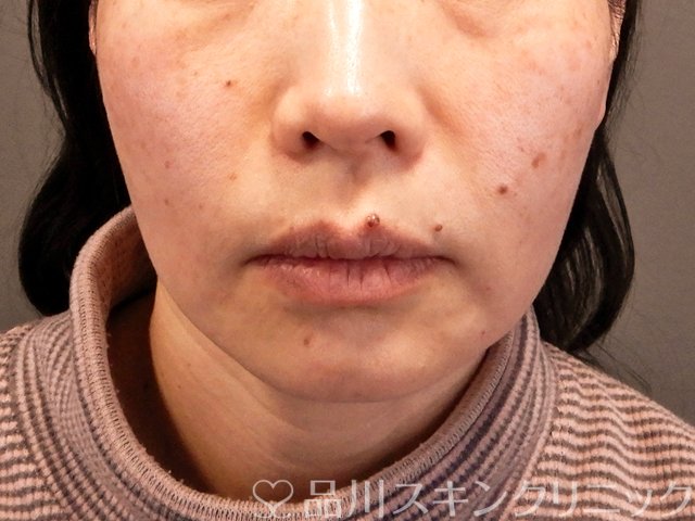 症例NO.70489のAFTER写真