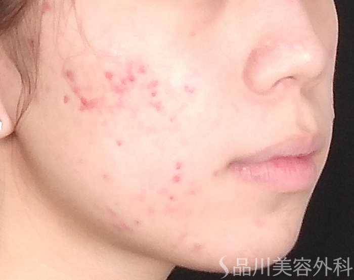 症例NO.72189のBEFORE写真