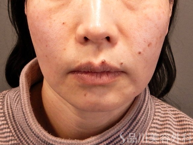 症例NO.70489のAFTER写真