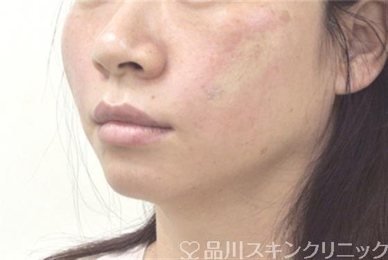 症例NO.29230のAFTER写真