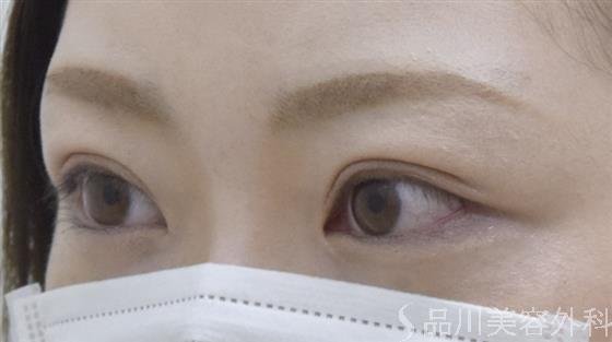 症例NO.53301のAFTER写真
