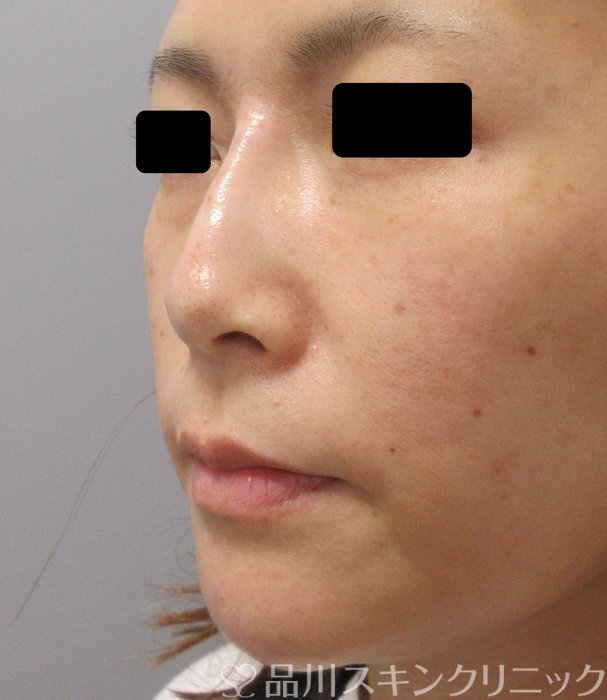 症例NO.73518のAFTER写真