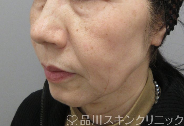 症例NO.70086のBEFORE写真