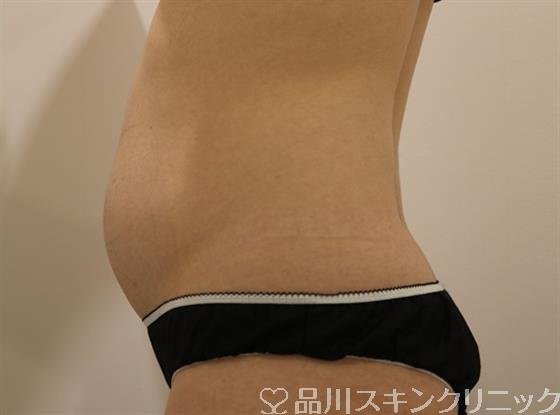 症例NO.43971のBEFORE写真