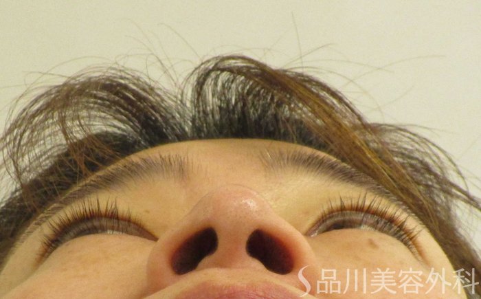 症例NO.70570のBEFORE写真