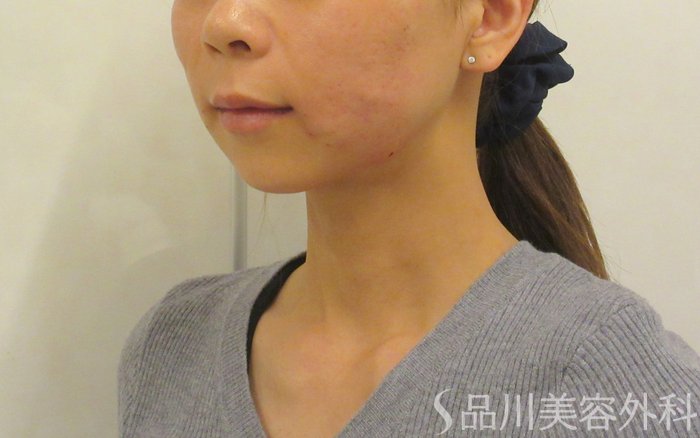 症例NO.74161のAFTER写真