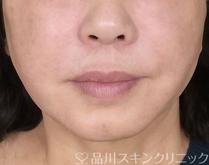 症例NO.68438のAFTER写真