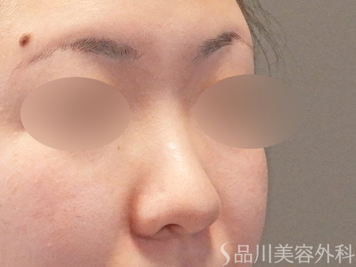 症例NO.64192のBEFORE写真