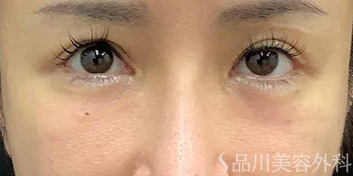 症例NO.67804のAFTER写真