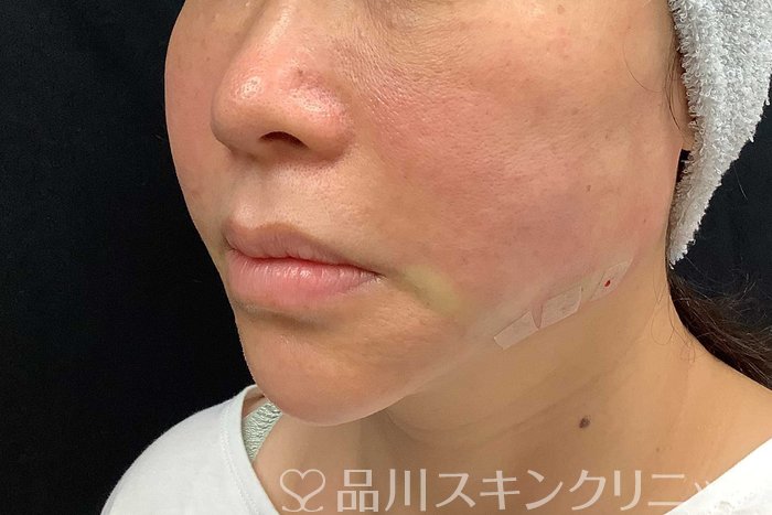 症例NO.69917のAFTER写真