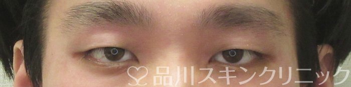 症例NO.74413のBEFORE写真