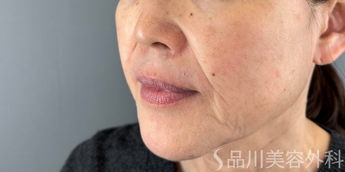 症例NO.73141のBEFORE写真