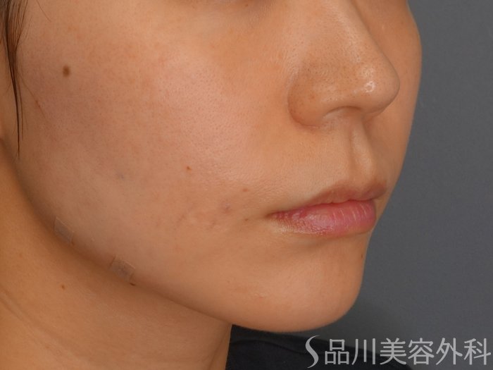 症例NO.73694のAFTER写真