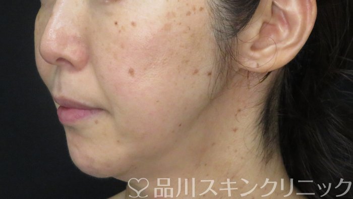 症例NO.71023のBEFORE写真