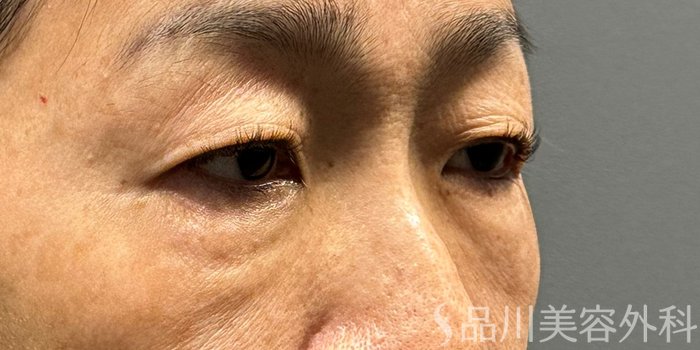 症例NO.68947のBEFORE写真