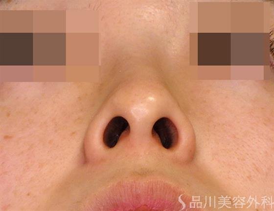 症例NO.47876のBEFORE写真