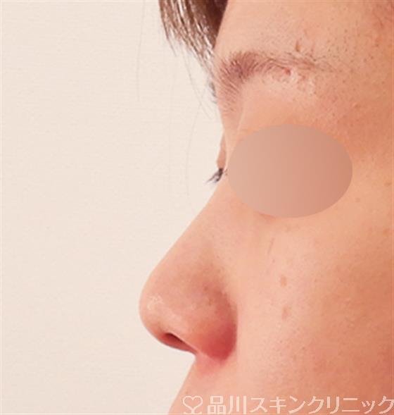症例NO.58211のBEFORE写真