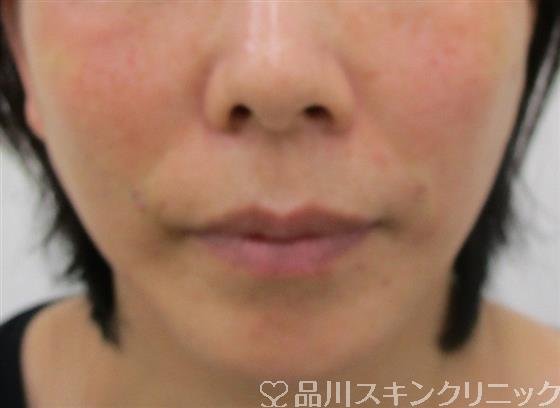 症例NO.37888のAFTER写真
