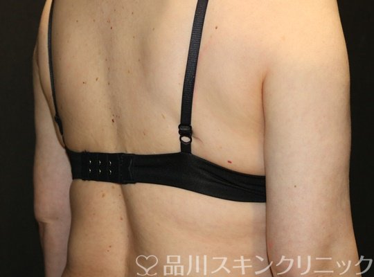 症例NO.70946のBEFORE写真