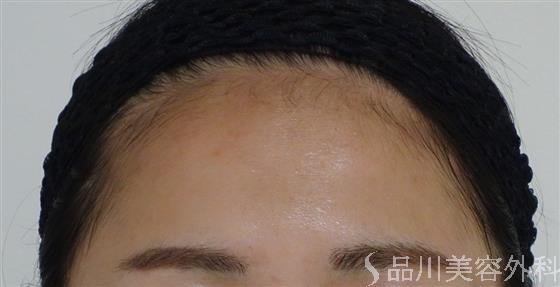症例NO.48425のBEFORE写真