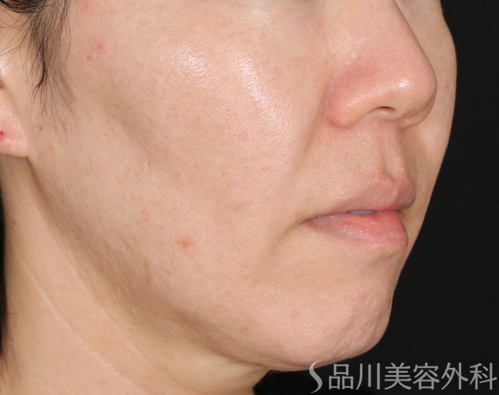 症例NO.70847のBEFORE写真