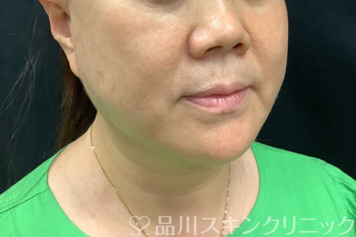 症例NO.71283のBEFORE写真