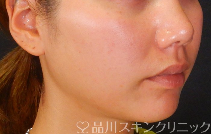 症例NO.65149のBEFORE写真