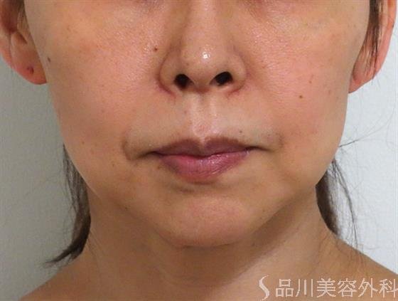 症例NO.35917のBEFORE写真