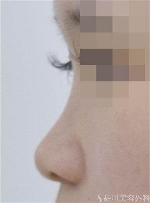 症例NO.50691のBEFORE写真