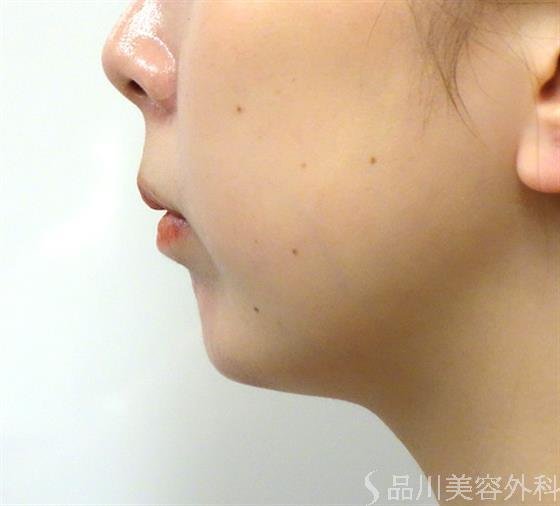 症例NO.35050のAFTER写真