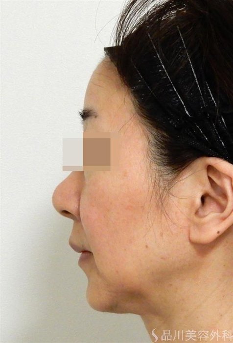 症例NO.38737のBEFORE写真