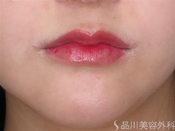 症例NO.47705のBEFORE写真
