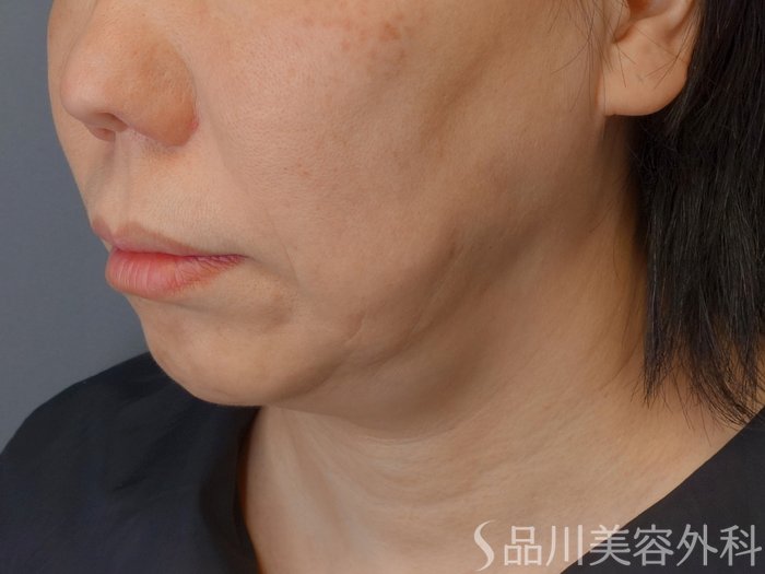 症例NO.72987のBEFORE写真