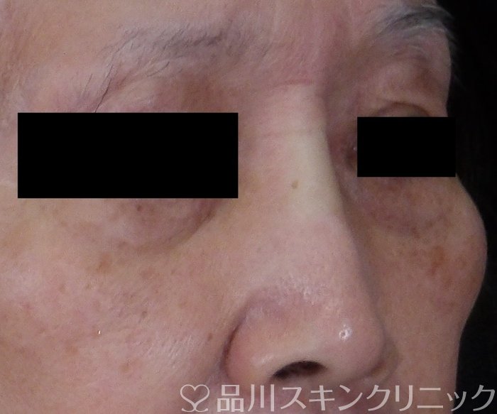 症例NO.70392のAFTER写真
