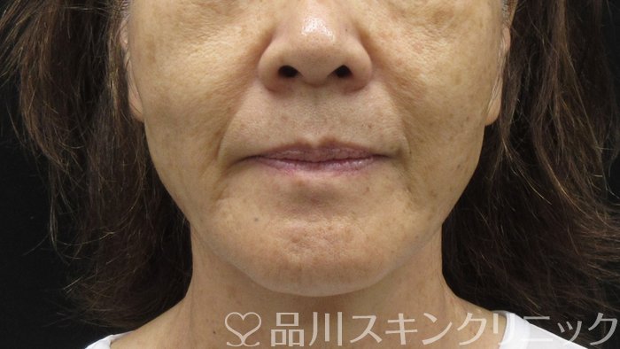 症例NO.71372のAFTER写真